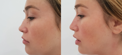 Nonsurgical Nose Job before and after photo
