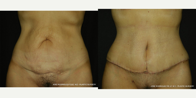 Tummy Tuck before and after photo