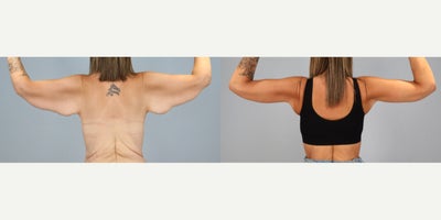 Arm Lift before and after photo