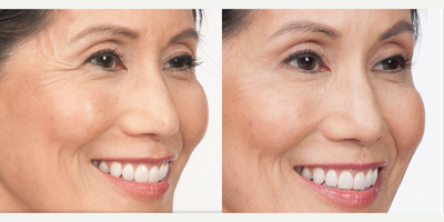 Botox before and after photo