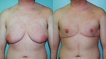 Breast Reduction before and after photo