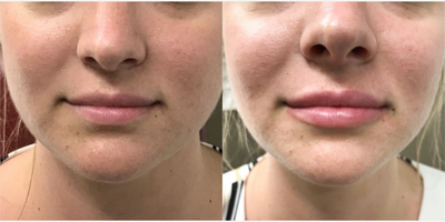 Dermal Fillers before and after photo