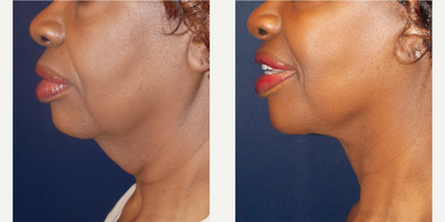 Facelift before and after photo