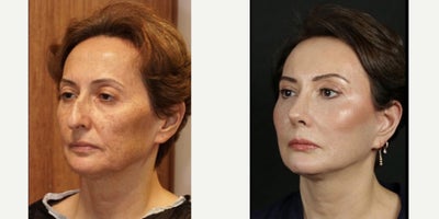 Facelift before and after photo