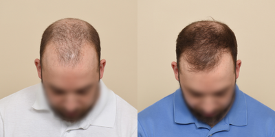 PRP for Hair Loss before and after photo