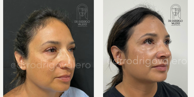 Rhinoplasty before and after photo
