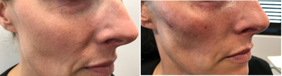 Dermal Fillers before and after photo