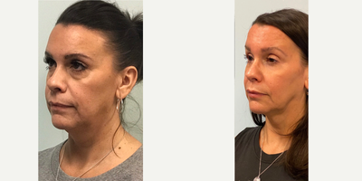 Nonsurgical Facelift before and after photo