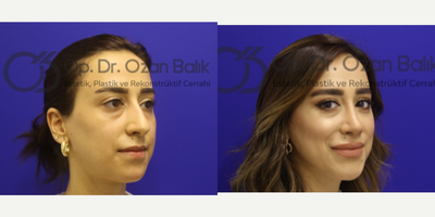 Rhinoplasty before and after photo
