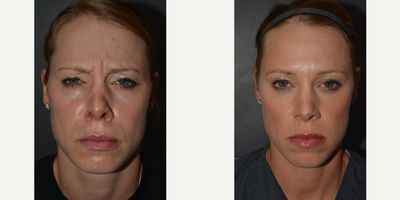 Botox before and after photo