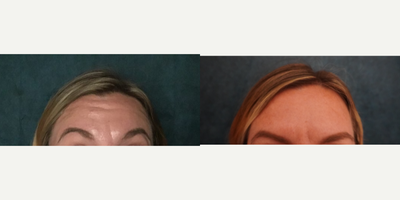 Botox before and after photo