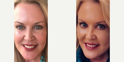 CO2 Laser before and after photo