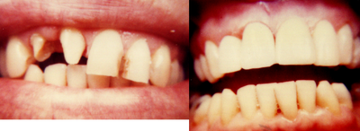 Dental Crown before and after photo