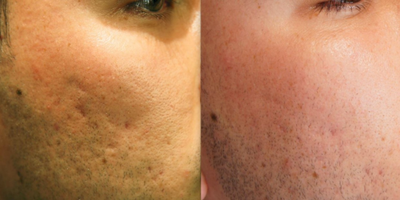 Microneedling RF before and after photo