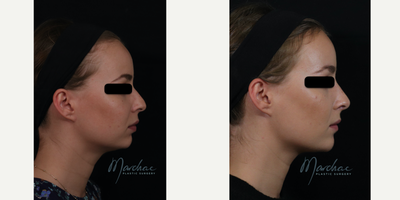 Nonsurgical Nose Job before and after photo