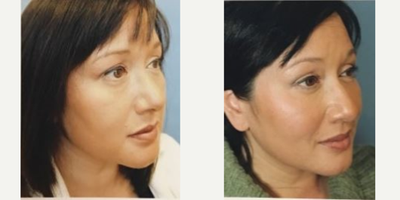 Sculptra before and after photo