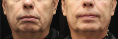 Skin Tightening before and after photo