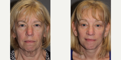 Brow Lift before and after photo