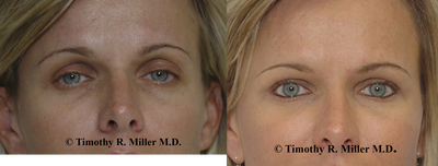 Facial Fat Transfer before and after photo