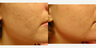 Fractional Laser before and after photo