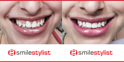Gum Lift before and after photo