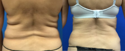 Liposuction before and after photo