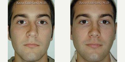 Rhinoplasty before and after photo