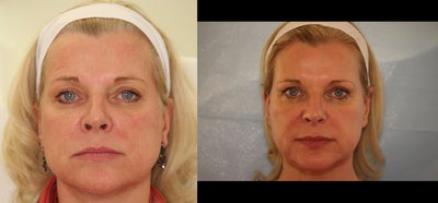 Sculptra before and after photo