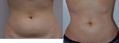 Smart Lipo before and after photo