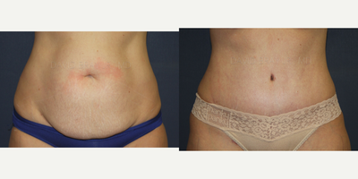 Tummy Tuck before and after photo