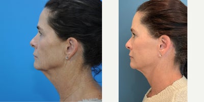 before and after image