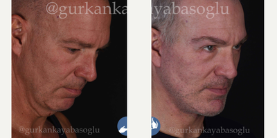 Facelift before and after photo