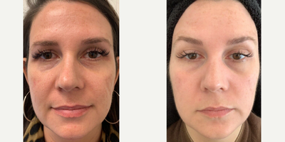 Fraxel Laser before and after photo