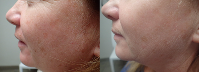 IPL before and after photo