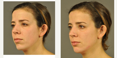 Juvederm before and after photo