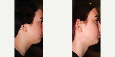 Kybella before and after photo