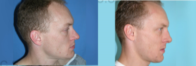 Rhinoplasty before and after photo