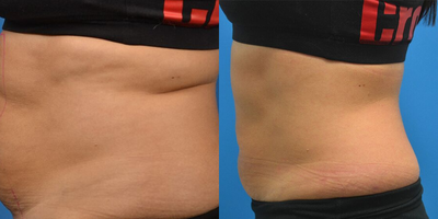 SculpSure before and after photo