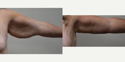 Arm Lift before and after photo