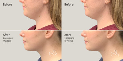 CoolSculpting before and after photo