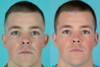 Ear Surgery before and after photo