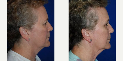 Eyelid Surgery before and after photo