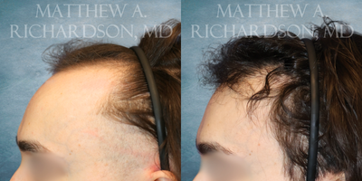 Hair Transplant before and after photo