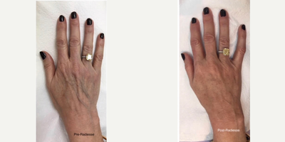 Radiesse before and after photo