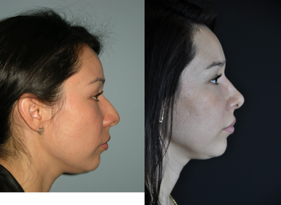 Rhinoplasty before and after photo
