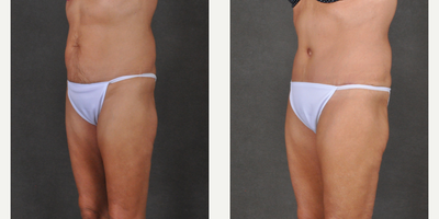 Tummy Tuck before and after photo