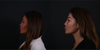 Asian Rhinoplasty before and after photo