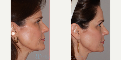 Botox before and after photo
