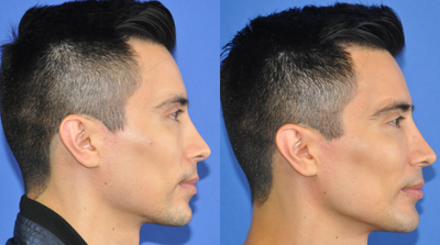 Chin Implant before and after photo