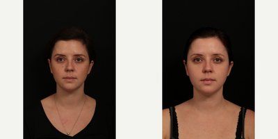 Fraxel Laser before and after photo